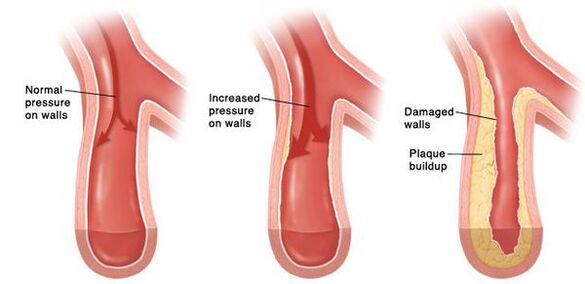 Bei Bluthochdruck liegt eine Verletzung der Durchlässigkeit des Gefäßbettes vor.